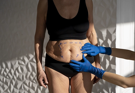 Qu’est-ce que l’Abdominoplastie ?